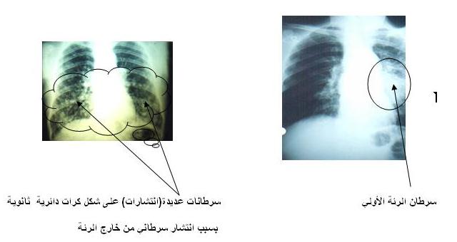 اعراض سرطان الرئة - تعرف على اعراض سرطان الرئة 3317 2