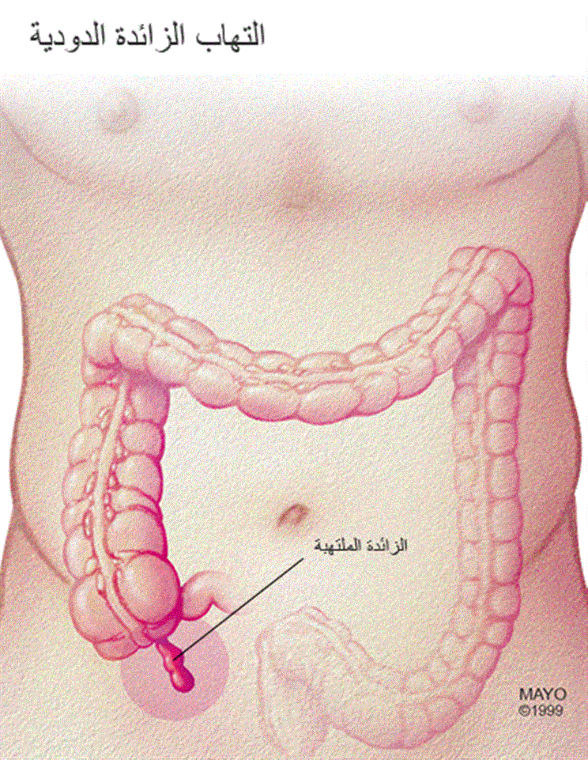 اعراض الزائدة الدودية - اسباب وظواهر وجود زائده دوديه 1949