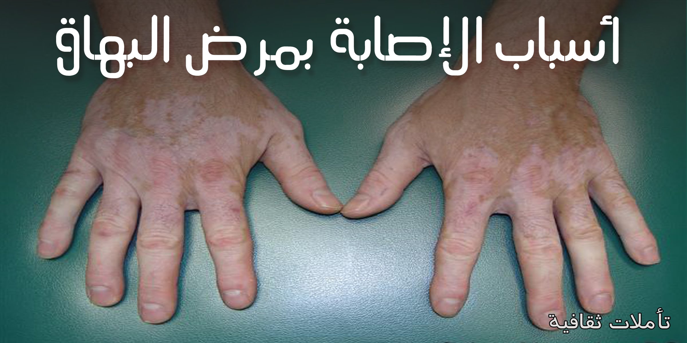 مرض البهاق - ماهو البهاق واسبابه وعلاجه 4058