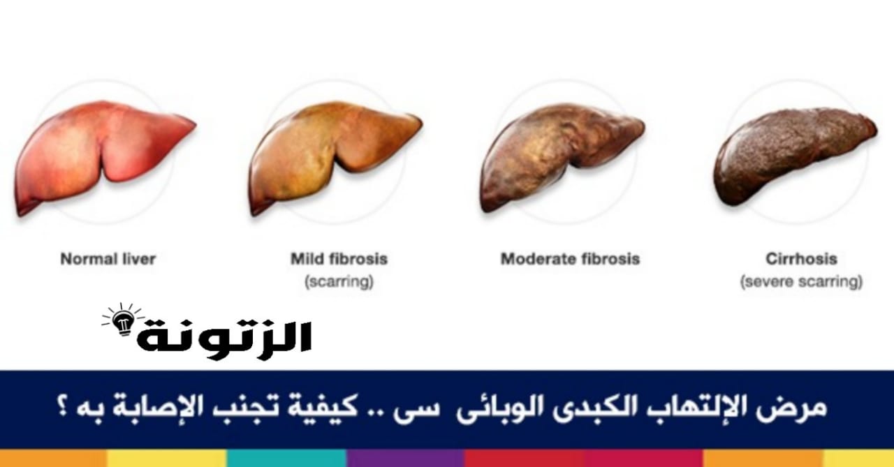 مرض الكبد الوبائي , تعرف علي اسباب وعلاج واعراض مرض التهاب الكبد