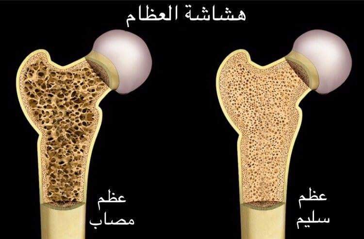 صور هشاشه العظام - اصعب المشاكل التى تواجه كبار السن 14350 11