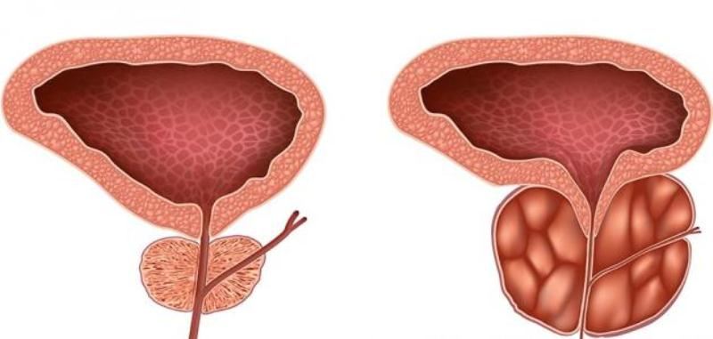 علاج تضخم البروستاتا - علاج تضخم البروستاتا بالاعشاب 2428 1