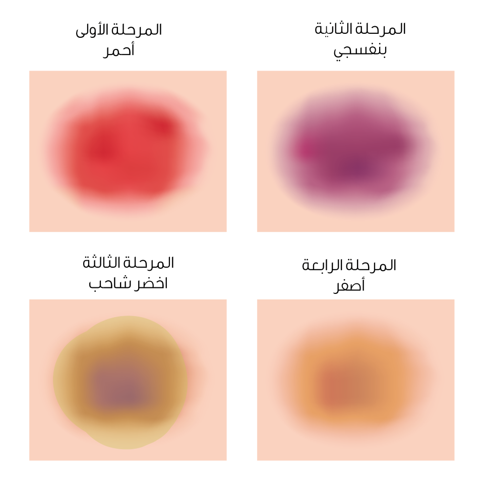 علاج كدمات الوجه - اسرع حل للكدمات 14435