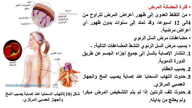 بحث عن مرض السل - التعريف بمرض السل و اعراضه 14632 9