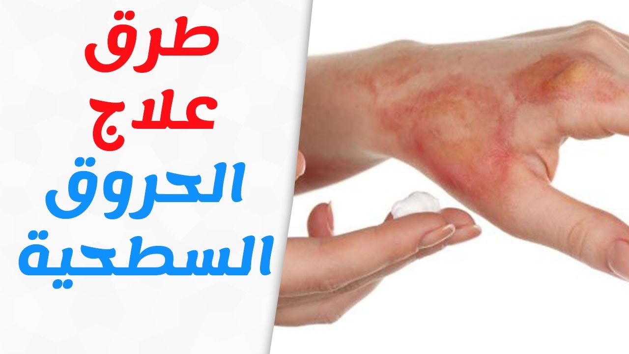 اثر وعلاج الحروق والجروح خطيرة , علاج الحروق