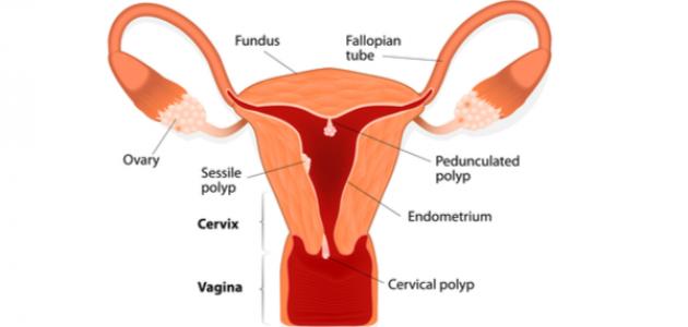 اعراض لحمية الرحم - هل هذا المرض خطير 14471 1
