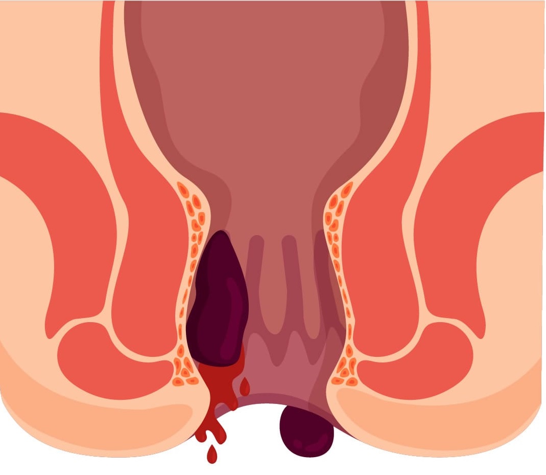 اصعب الم واغرب اعراض ممكن يحسها الانسان , اعراض البواسير