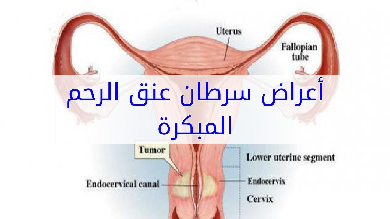 اعراض سرطان الرحم - اهم اعراض سرطان الرحم 2590