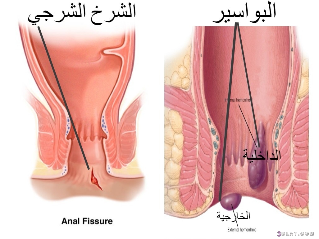 اكثر الاشياء التي تسبب البواسير , اسباب البواسير