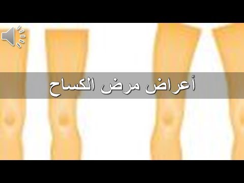 مرض الكساح - تعرف علي مرض الكساح 0 1