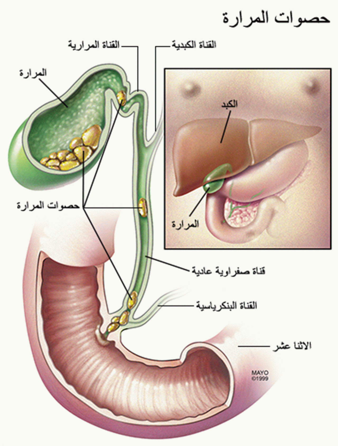 اعراض المرارة , اصعب الاعراض التي تسببها المراره