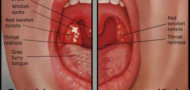 علاج احتقان الزور , زورى محتقن ماذا افعل