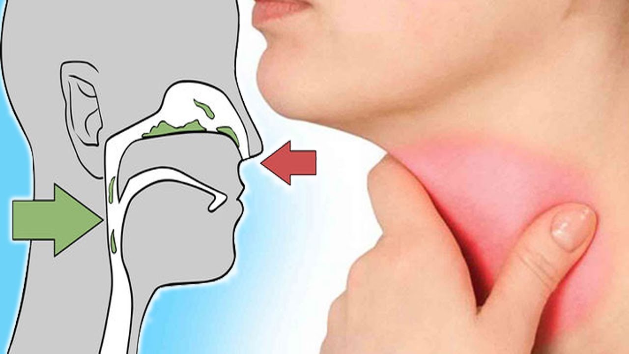 التخلص من البلغم , طرق علاج البلغم واسبابه