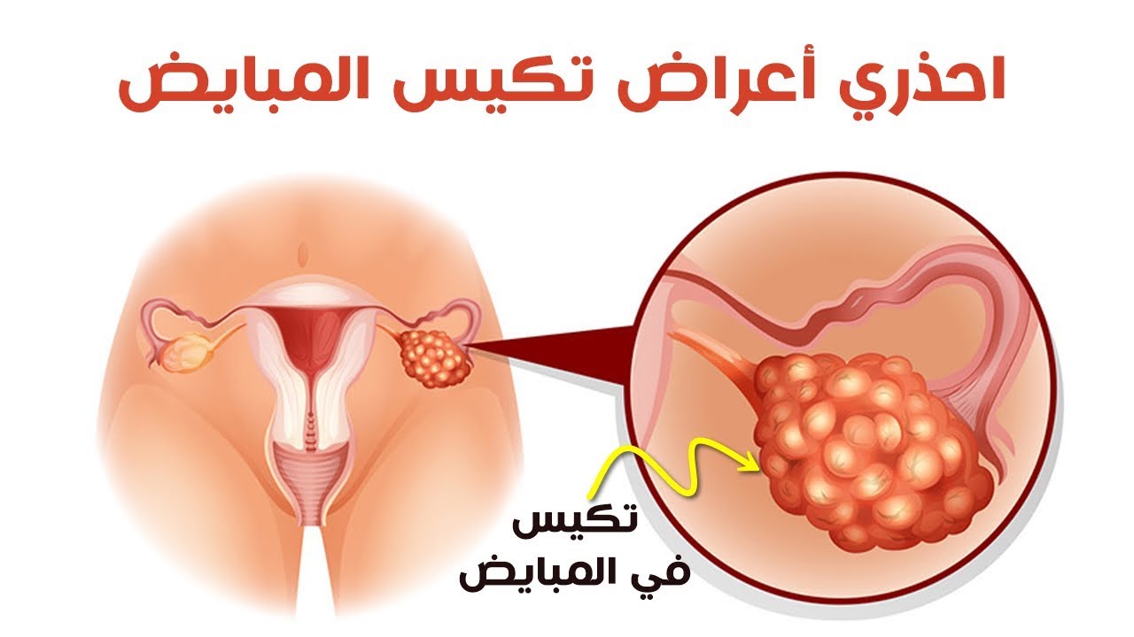 ماهي اعراض تكيس المبايض- اكتر مرض بيمنع الحمل 3137