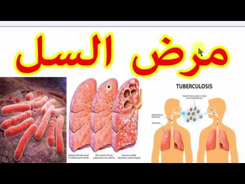 بحث عن مرض السل , التعريف بمرض السل و اعراضه