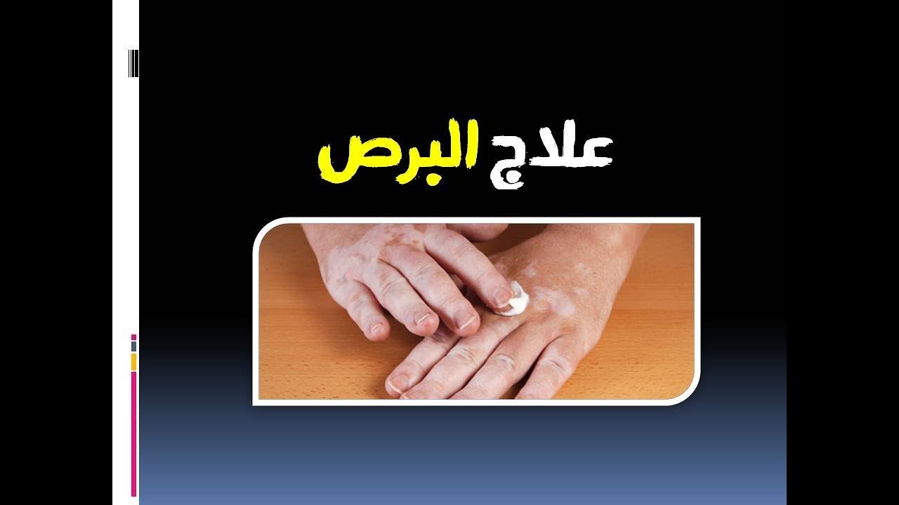 علاج البرص , اسباب واعراض وطرق علاج البهاق