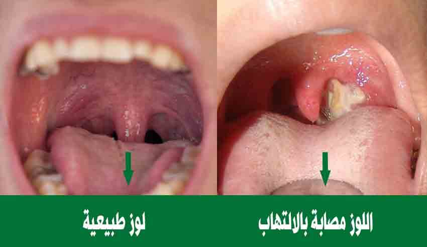 اعراض التهاب اللوزتين , تعرف على اعراض التهاب اللوزتين