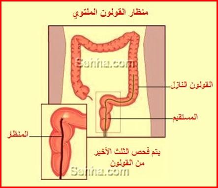 اعراض التهاب القولون - اسباب القولون و علاجه 5258 2