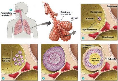 بحث عن مرض السل - التعريف بمرض السل و اعراضه 14632 3