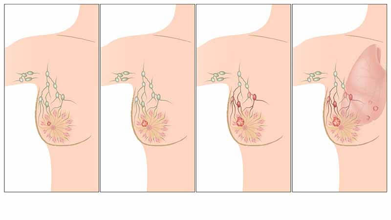 كيف اعرف اني مصابة بسرطان الثدي بالصور - هل اعانى من مرض سرطان الثدى 14578 2
