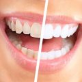 2244 1-Jpeg كيفية تبييض الاسنان - طريقة سريعة لتبيض الاسنان تذكير صفا