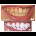 2819 1 خلطات تبيض الاسنان - وصفات لتبيض الاسنان امتنان هاجد