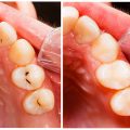 2693 3 علاج تسوس الاسنان - وصفات للتخلص من التسوس تذكير صفا