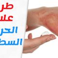 5806 3 اثر وعلاج الحروق والجروح خطيرة - علاج الحروق نورهان خميس